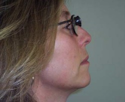side view of woman with head tilted slightly up, wearing bioptic lens
