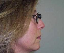 side view of woman wearing bioptic spectacles looking straight ahead, through the telescopic view