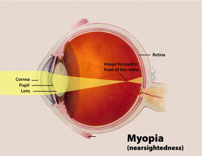 diagram of the myopic eye from the National Eye Institute, showing how light rays are brought to focus in front of the retina, i.e. falling short of the back of the eye