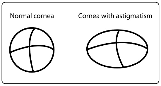 diagram showing the shape of a normal cornea, and the elongated, football-shaped cornea of someone with astigmatism