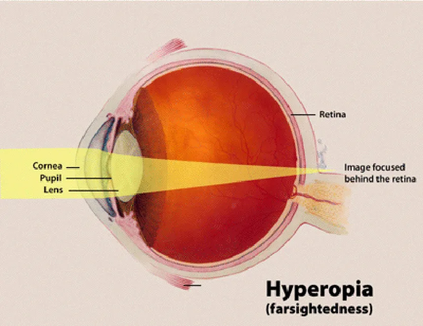 diagram of hyperopia (farsightedness)