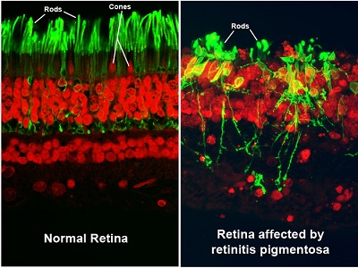 These images show a section of retina tissue from the back of the eye, as seen through a high-resolution microscope. The left image illustrates a normal retina, while the right image shows a retina affected by a condition called retinitis pigmentosa (RP).