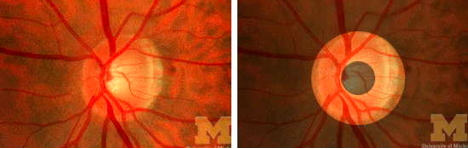 The normal optic disc is shaped like a donut. Source: University of Michigan College Eye Center
