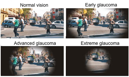 Examples of normal vision, early glaucoma, advanced glaucoma and extreme glaucoma