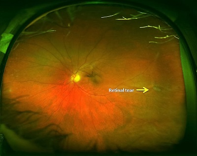 retina with small tear (text: retinal tear)
