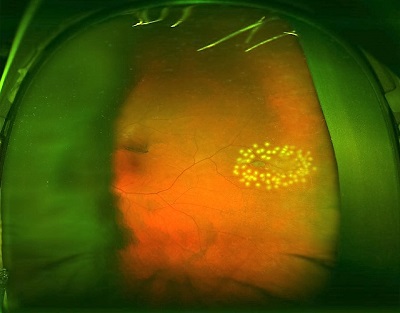 retinal tear after laser treatment