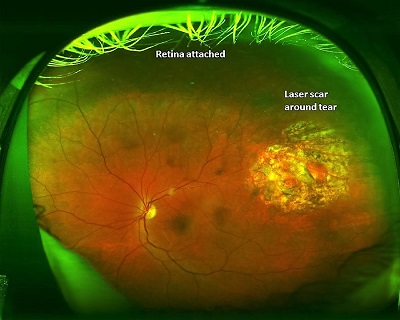 retinal detachment after treatment