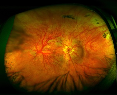 a fundus showing albinism
