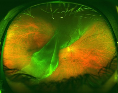 a giant retinal tear with retinal detachment before treatment