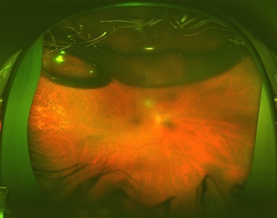 a giant retinal tear after replacement with a scleral buckle and gas
