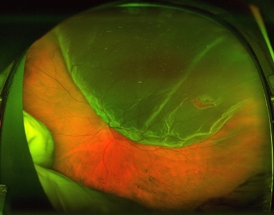 retinal detachment before treatment
