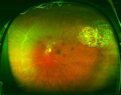 retinal attachment after gas bubble is gone
