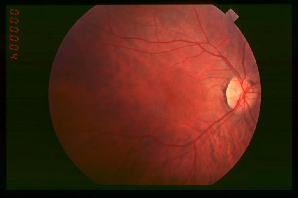 Source	Retinitis pigmentosa by Christian Hamel
Author	Christian Hamel
Permission
(Reusing this file)	
© 2006 Hamel; licensee BioMed Central Ltd.