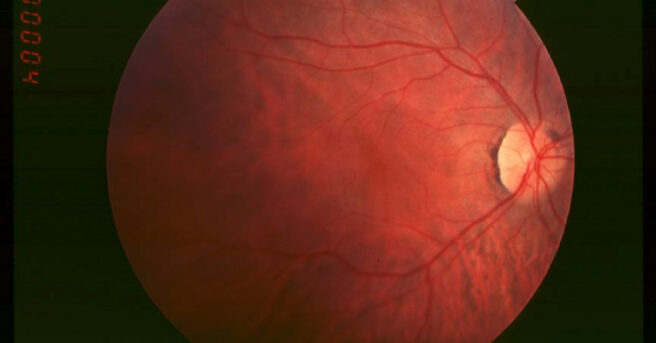 Fundus of patient with retinitis pigmentosa