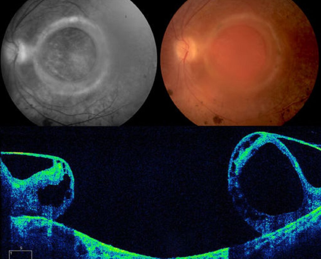 A large full thickness macular hole in a middle-aged female. Photo Source: Retina Gallery