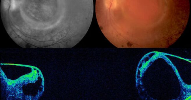 A large full thickness macular hole in a middle-aged female. Photo Source: Retina Gallery