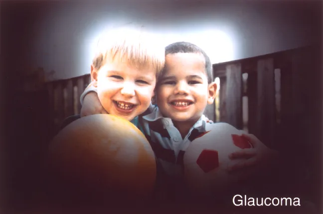 person view that has glaucoma photo courtesy National Eye Institute