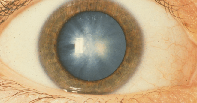 A white congenital cataract. photo courtesy National Eye Institute media library