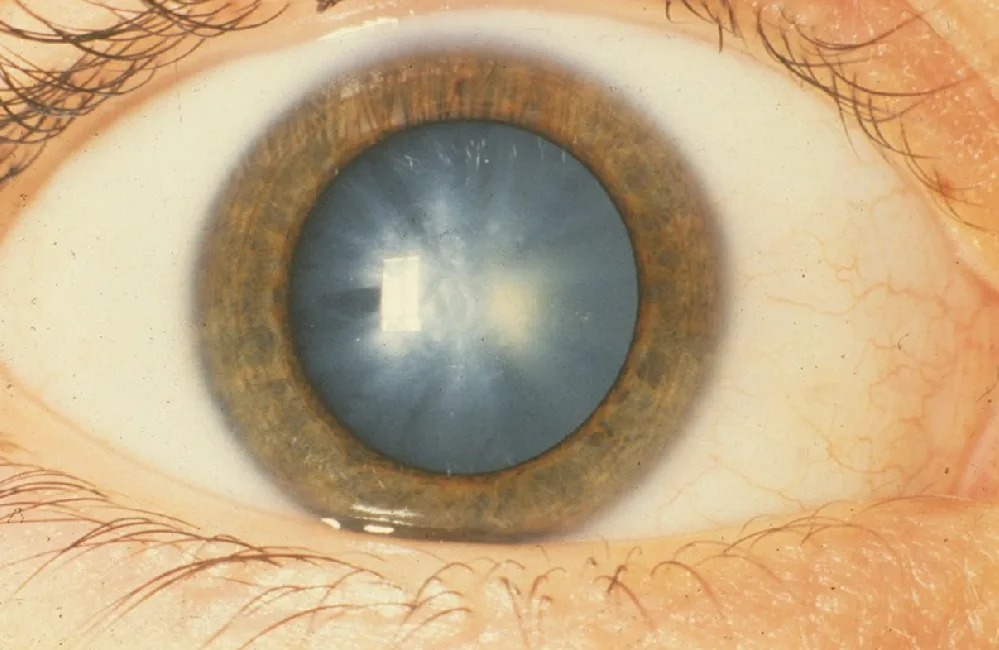 A white congenital cataract. photo courtesy National Eye Institute media library
