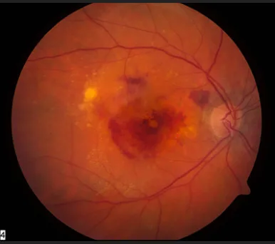 A fundus photo showing advanced age-related macular degeneration courtesy National Eye Institute Media Library
