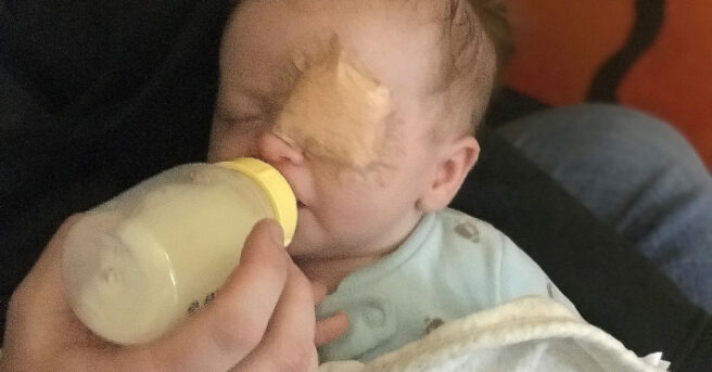 An infant with an eyepatch drinking from a bottle