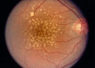 Dry Macular Degeneration Showing Drusen