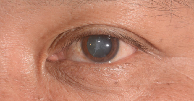 close up of the cataract during eye examination,