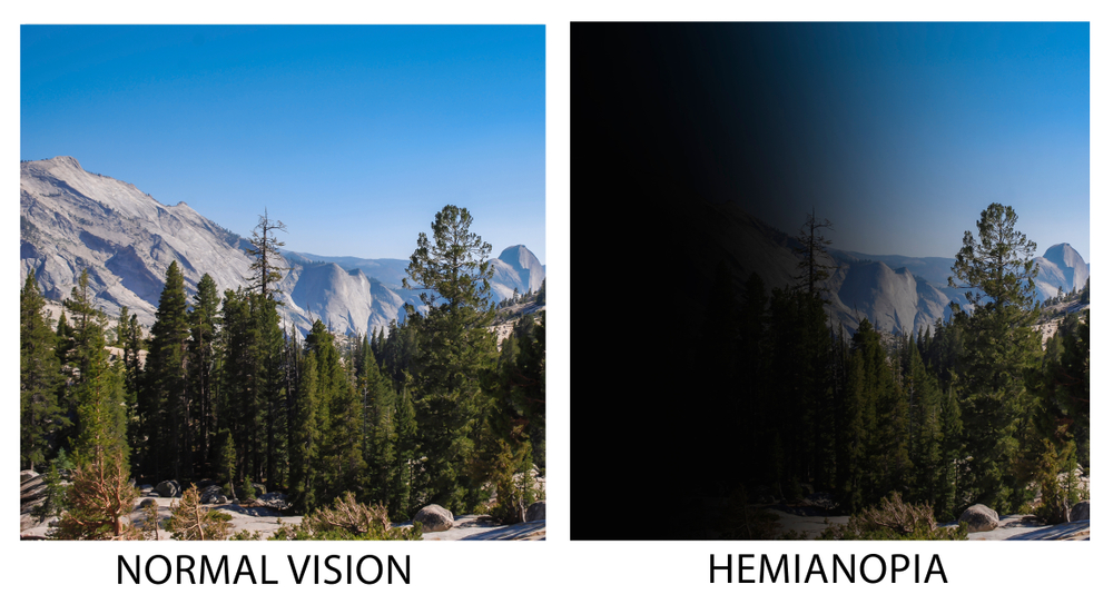 Hemianopsia, or hemianopia, is a less vision or blindness (anopsia) in half the visual field, usually on one side of the vertical midline.