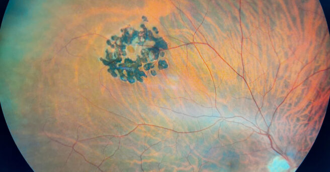 Photograph of Retina showing Laser treatment to Hole in Retina
