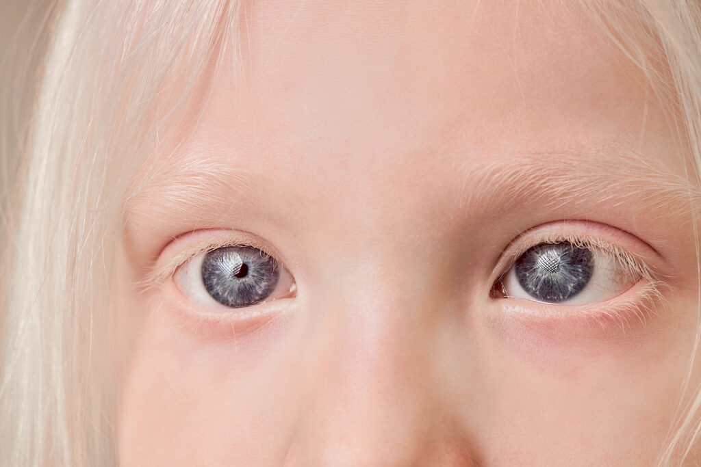 Close up of child’s with albinisms eyes.