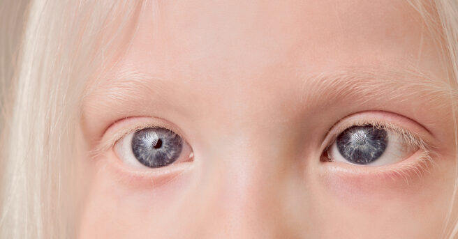 Close up of child’s with albinisms eyes.