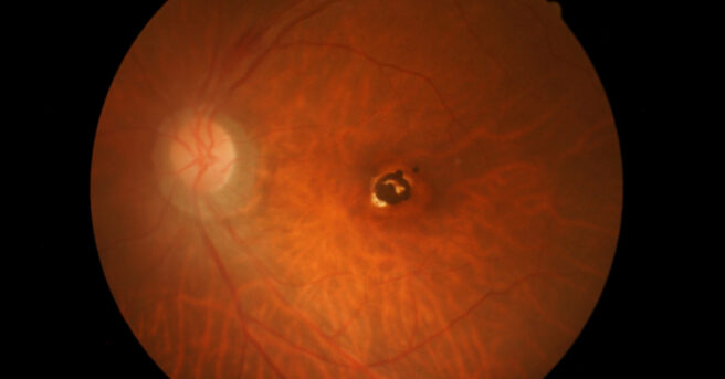Photo of macular hole
