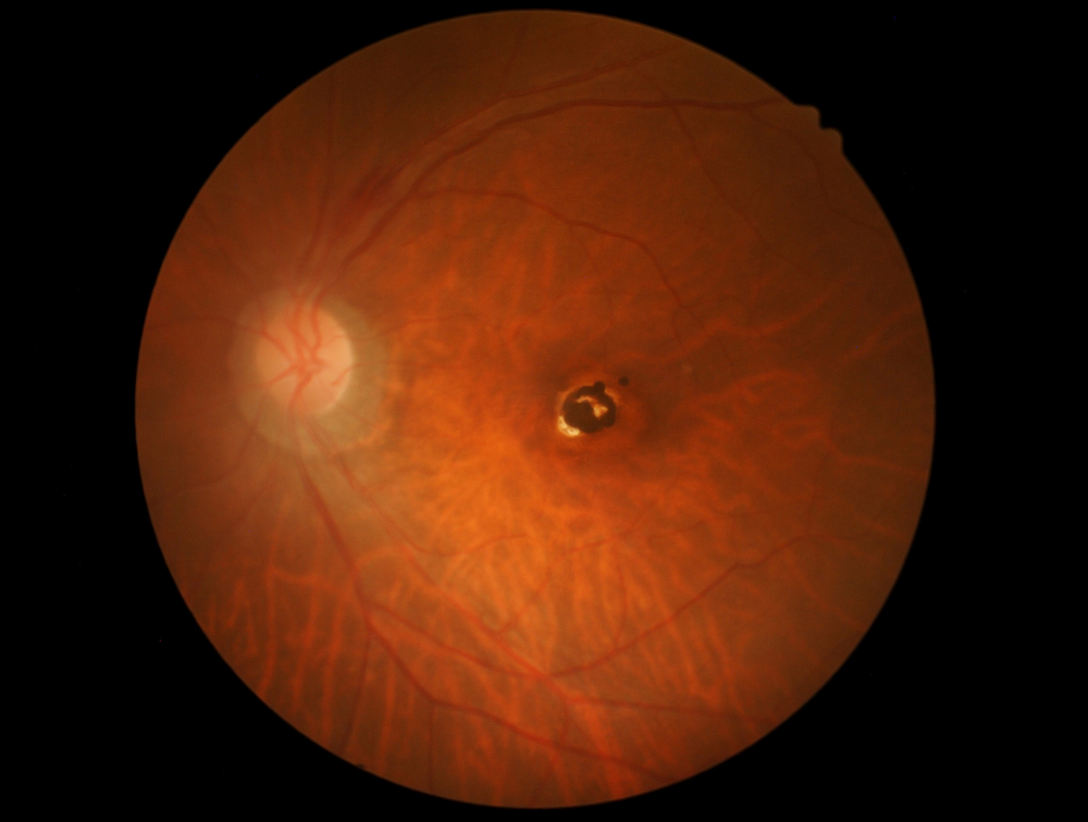 Photo of macular hole