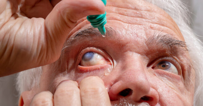 Self-instillation of eye drops in patients with glaucoma eyes. An elderly man with glaucoma.